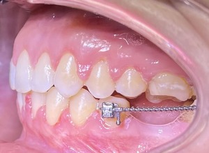 Установка несъемных проволочных ретейнеров и изготовление кап
