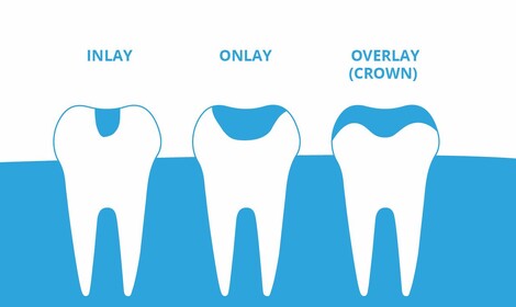 Вкладки Inlay и Onlay