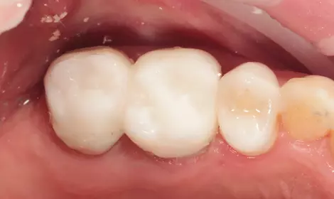 Временные коронки Cerec