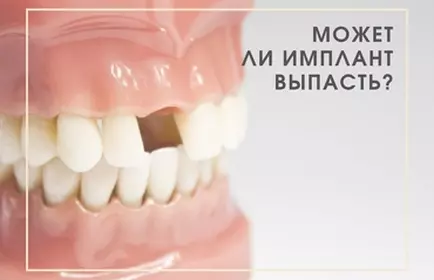 Выпадение имплантов