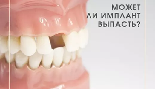 Выпадение имплантов