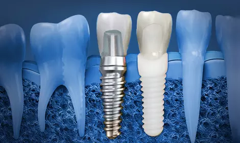Медицинский титан в стоматологии