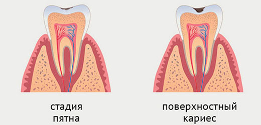 стадии развития кариеса