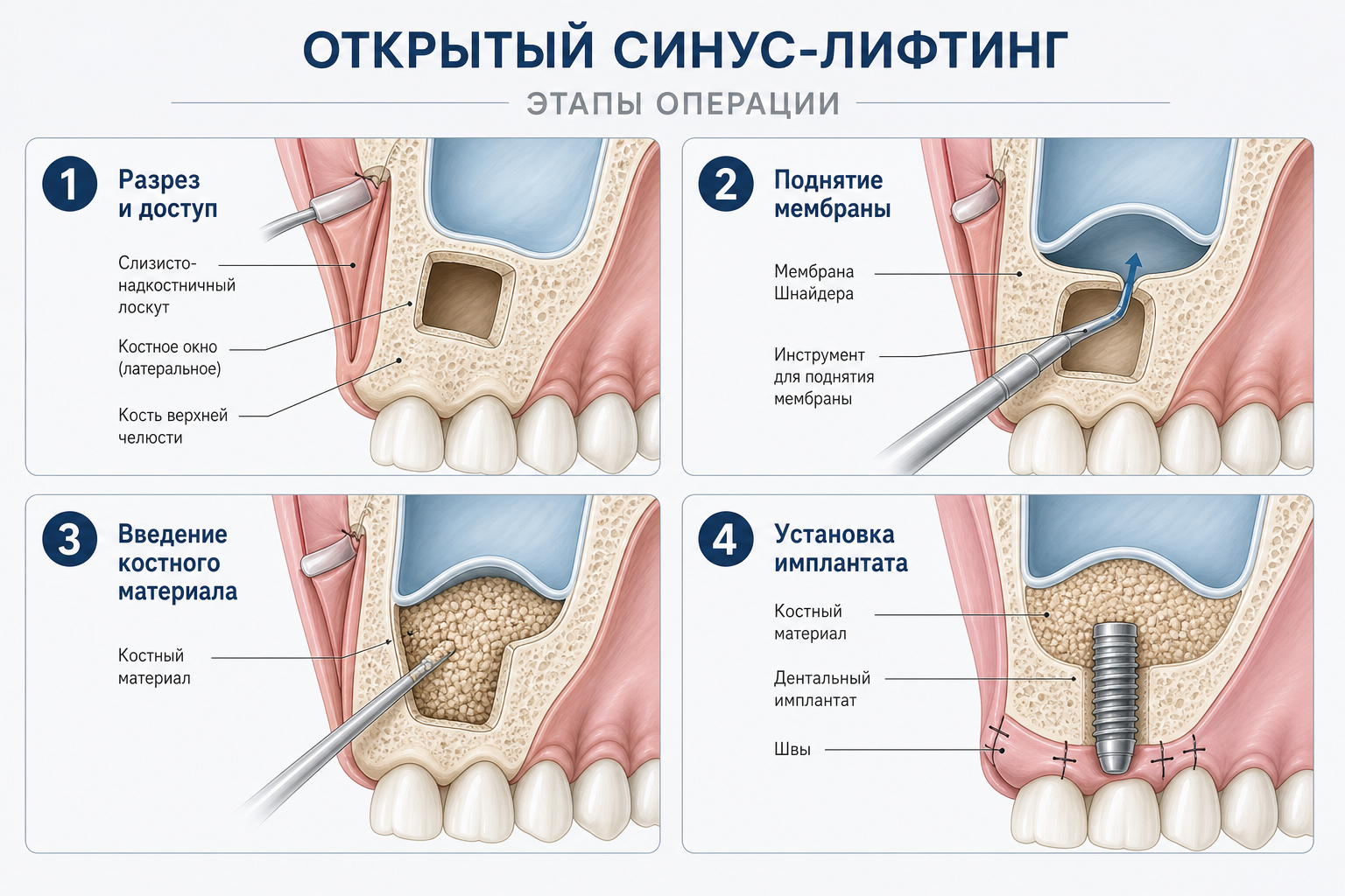 этапы синус лифтинга пошагово