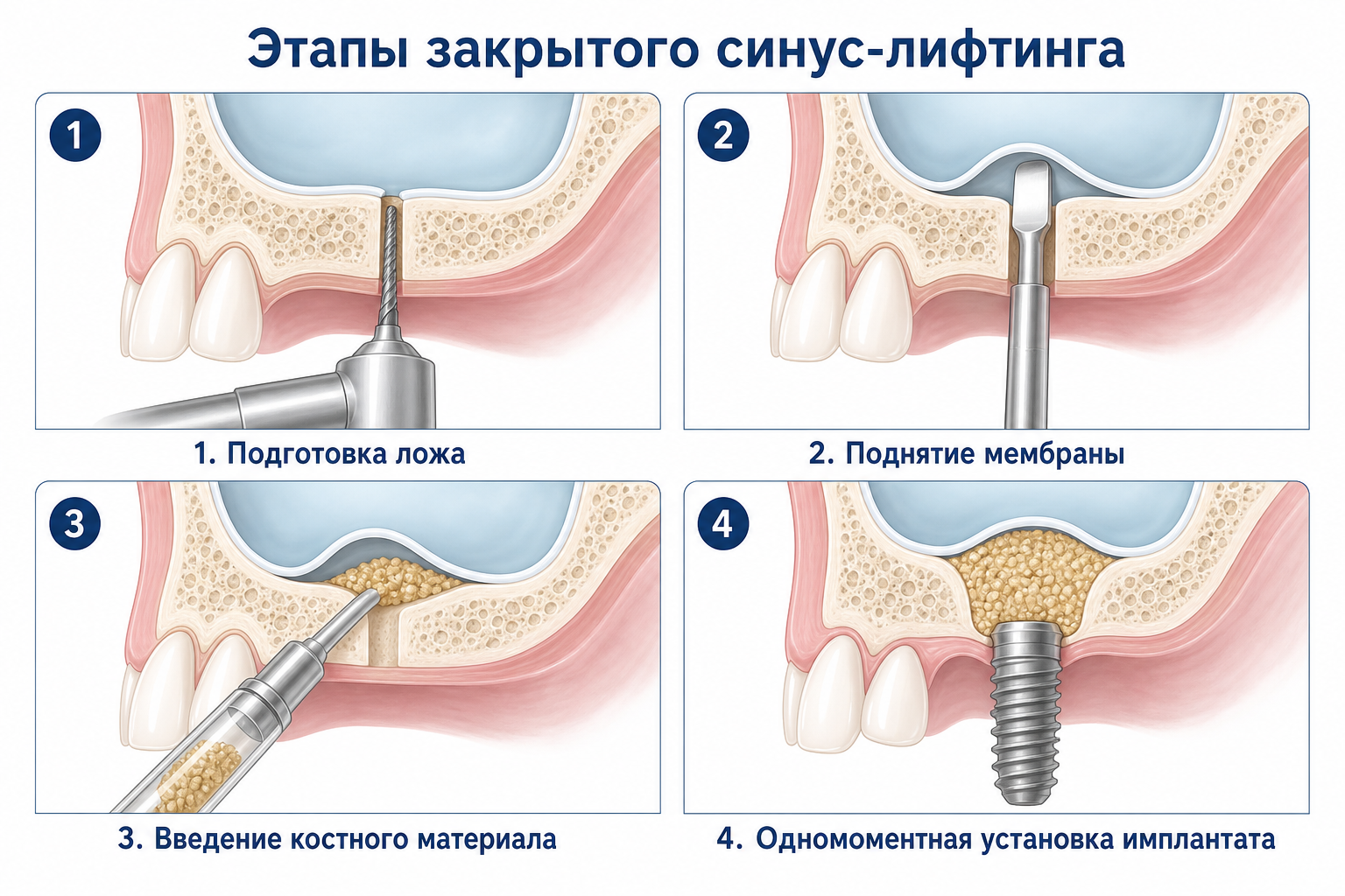 этапы операции закрытый синус лифтинг